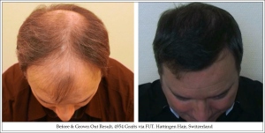 Before & Grown Out Result, 4954 Grafts via FUT. Hattingen Hair, Switzerland