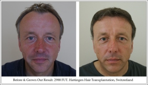 Front. Before & Grown Out Result. 2988 FUT. Hattingen Hair Transplantation, Switzerland