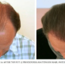 Hair Transplant Results. Hattingen Hair Transplantation (13)