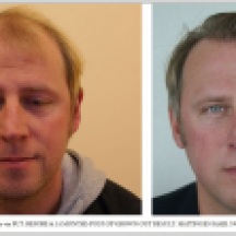 Hair Transplant Results. Hattingen Hair Transplantation (4)