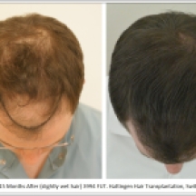 Hair Transplant Results. Hattingen Hair Transplantation (5)