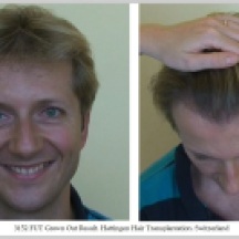 Hair Transplant Results. Hattingen Hair Transplantation (8)