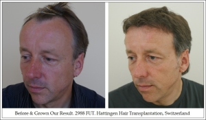 Left. Before & Grown Our Result. 2988 FUT. Hattingen Hair Transplantation, Switzerland