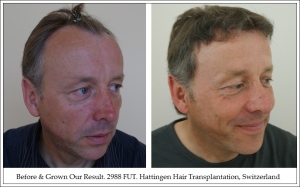 Right. Before & Grown Our Result. 2988 FUT. Hattingen Hair Transplantation, Switzerland