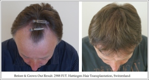 Top. Before & Grown Out Result. 2988 FUT. Hattingen Hair Transplantation, Switzerland
