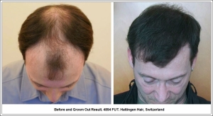 Before and Grown Out Result. 4894 FUT. Hattingen Hair, Switzerland 1