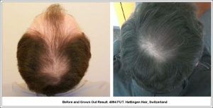 Before and Grown Out Result. 4894 FUT. Hattingen Hair, Switzerland 2