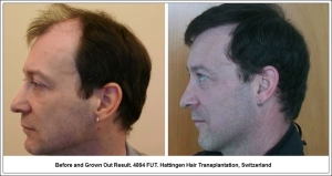 Before and Grown Out Result. 4894 FUT. Hattingen Hair Transplantation, Switzerland 4