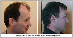 Before and Grown Out Result. 4894 FUT. Hattingen Hair Transplantation, Switzerland 5