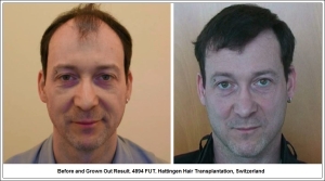 Before and Grown Out Result. 4894 FUT. Hattingen Hair Transplantation, Switzerland