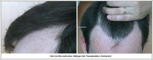 Hair Line Reconstruction. Hattingen Hair Transplantation, Switzerland