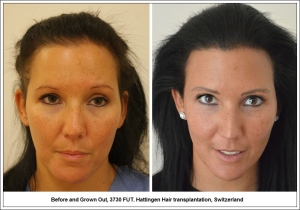 Before and Grown Out, 3730 FUT. Hattingen Hair transplantation, Switzerland 1