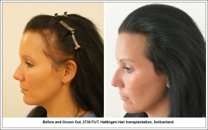 Before and Grown Out, 3730 FUT. Hattingen Hair transplantation, Switzerland 2