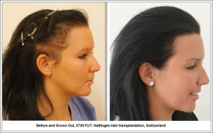 Before and Grown Out, 3730 FUT. Hattingen Hair transplantation, Switzerland 3