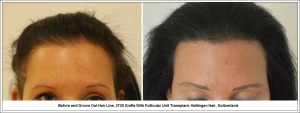 Before and Grown Out Hair Line, 3730 Grafts With Follicular Unit Transplant. Hattingen Hair, Switzerland