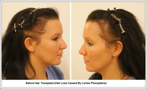 Before Hair Transplant (Hair Loss Caused By Lichen Planopilaris) 1