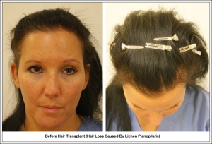 Before Hair Transplant (Hair Loss Caused By Lichen Planopilaris)