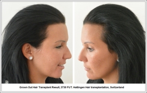 Grown Out Hair Transplant Result, 3730 FUT. Hattingen Hair transplantation, Switzerland